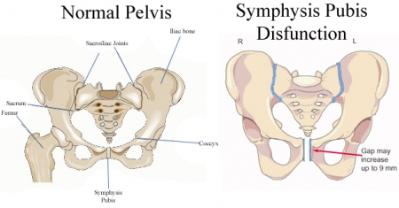 Relieve Pubic Symphysis Pain with Massage